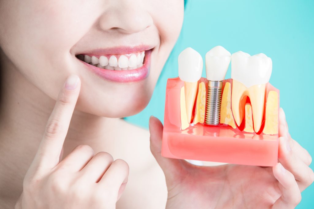 Woman Holding A Dental Implant Model