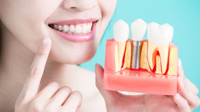 Woman Holding A Dental Implant Model