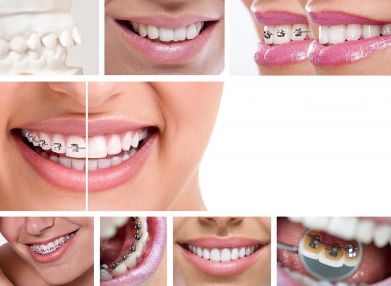 The Science Behind Braces How They Really Work American Environics